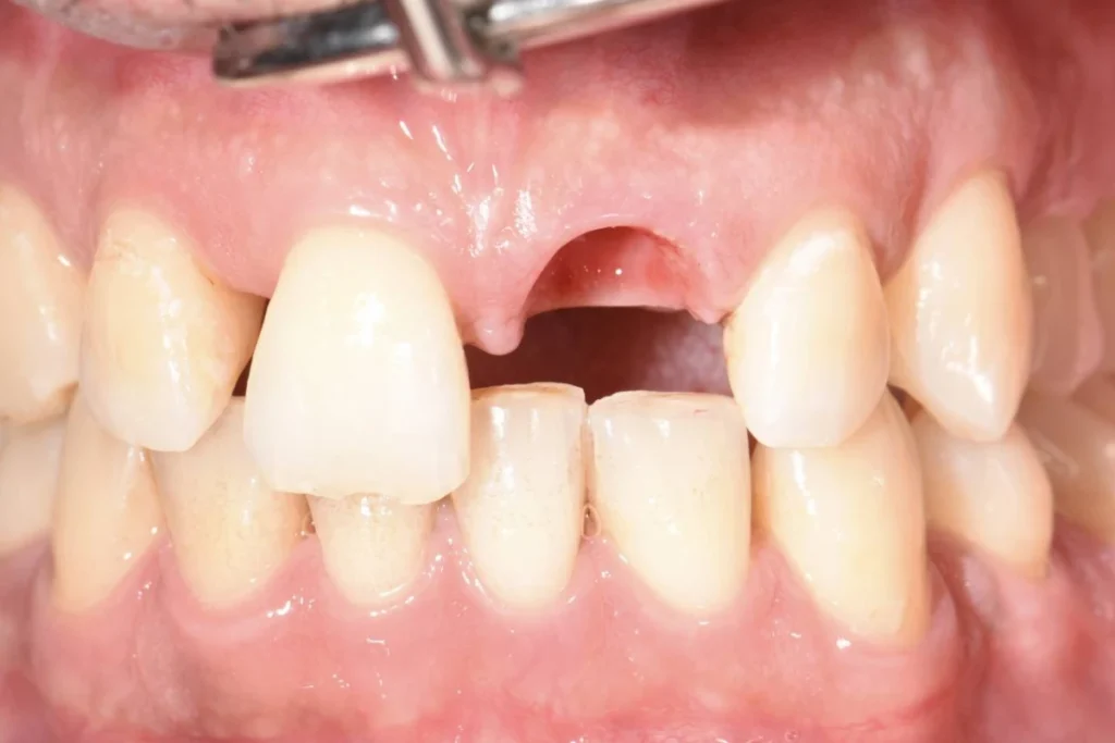 implants dentaires paris Implants dentaires | Dentiste à Paris 17 Dr Youri Emsallem Implants dentaires Paris 17