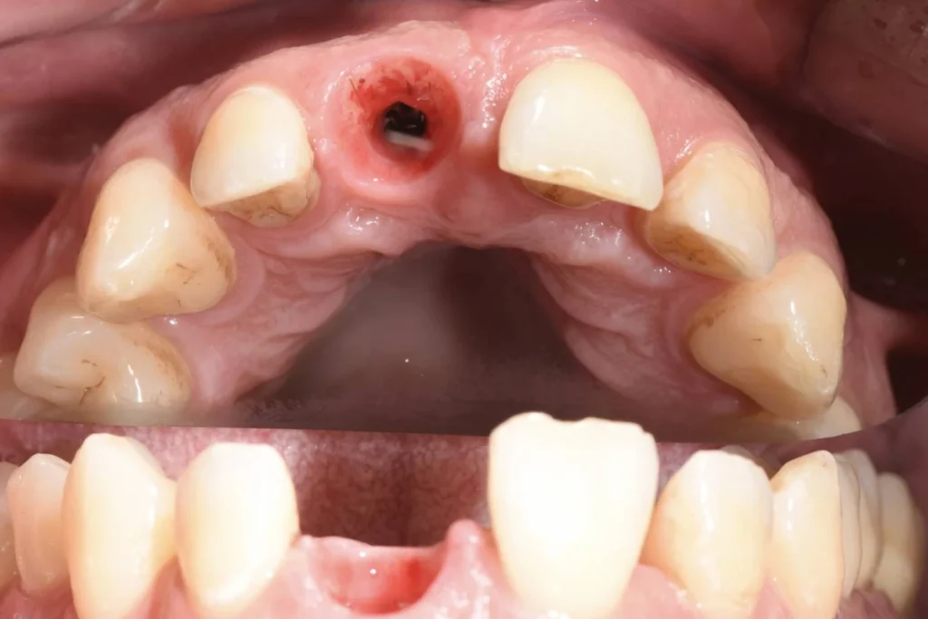 implants dentaires paris Implants dentaires | Dentiste à Paris 17 Dr Youri Emsallem Implants dentaires Paris 17