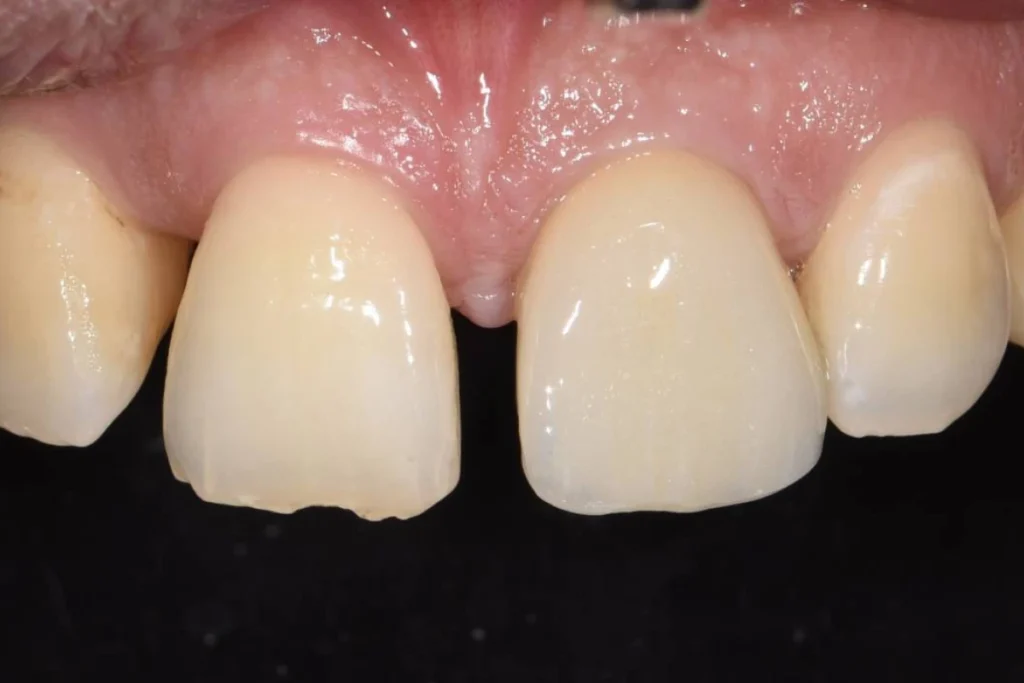 implants dentaires paris Implants dentaires | Dentiste à Paris 17 Dr Youri Emsallem Implants dentaires Paris 17