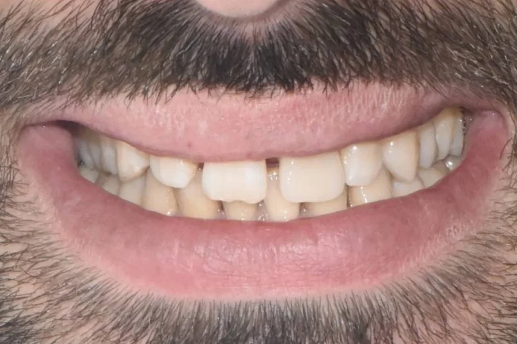 implants dentaires paris Implants dentaires | Dentiste à Paris 17 Dr Youri Emsallem Implants dentaires Paris 17