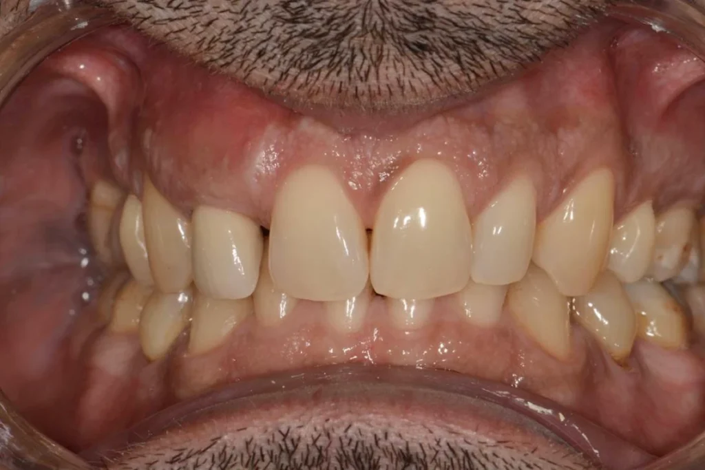 implants dentaires paris Implants dentaires | Dentiste à Paris 17 Dr Youri Emsallem Implants dentaires Paris 17