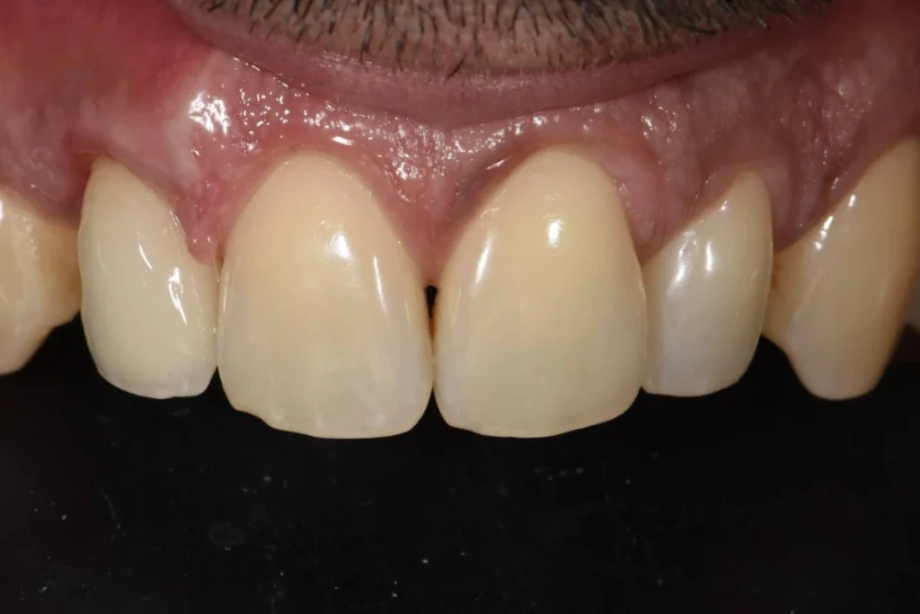 implants dentaires paris Implants dentaires | Dentiste à Paris 17 Dr Youri Emsallem Implants dentaires Paris 17