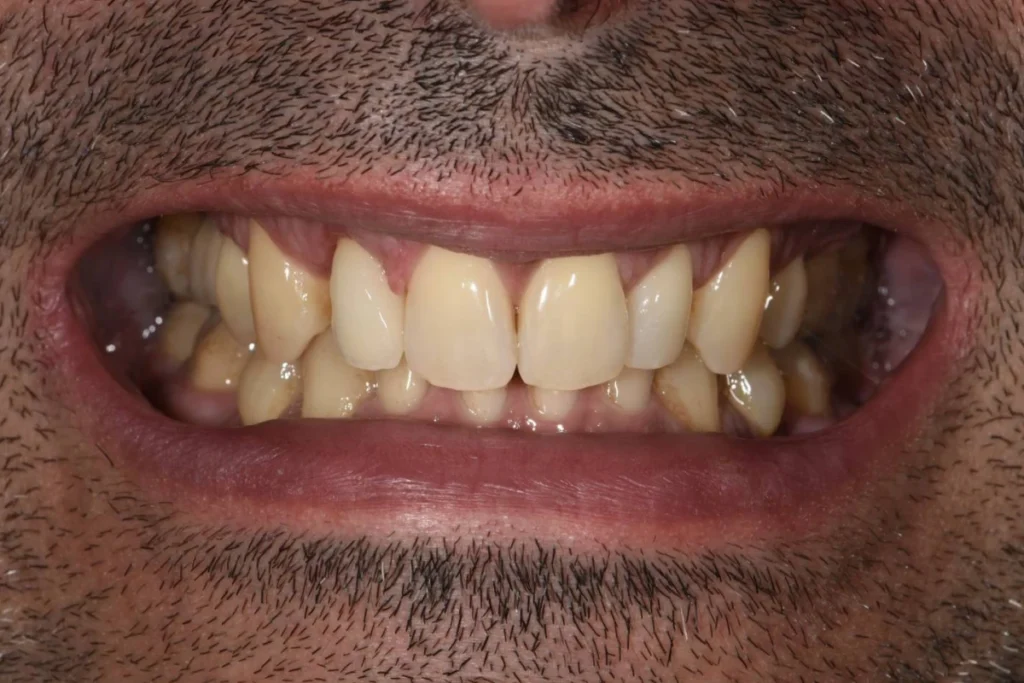 implants dentaires paris Implants dentaires | Dentiste à Paris 17 Dr Youri Emsallem Implants dentaires Paris 17