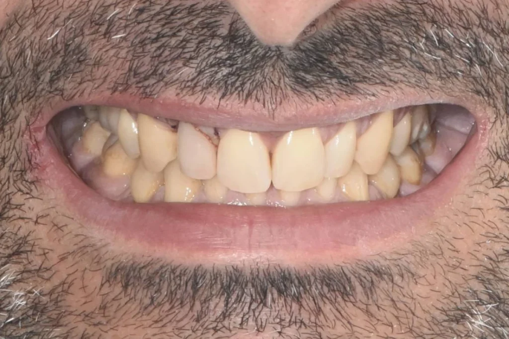 implants dentaires paris Implants dentaires | Dentiste à Paris 17 Dr Youri Emsallem Implants dentaires Paris 17
