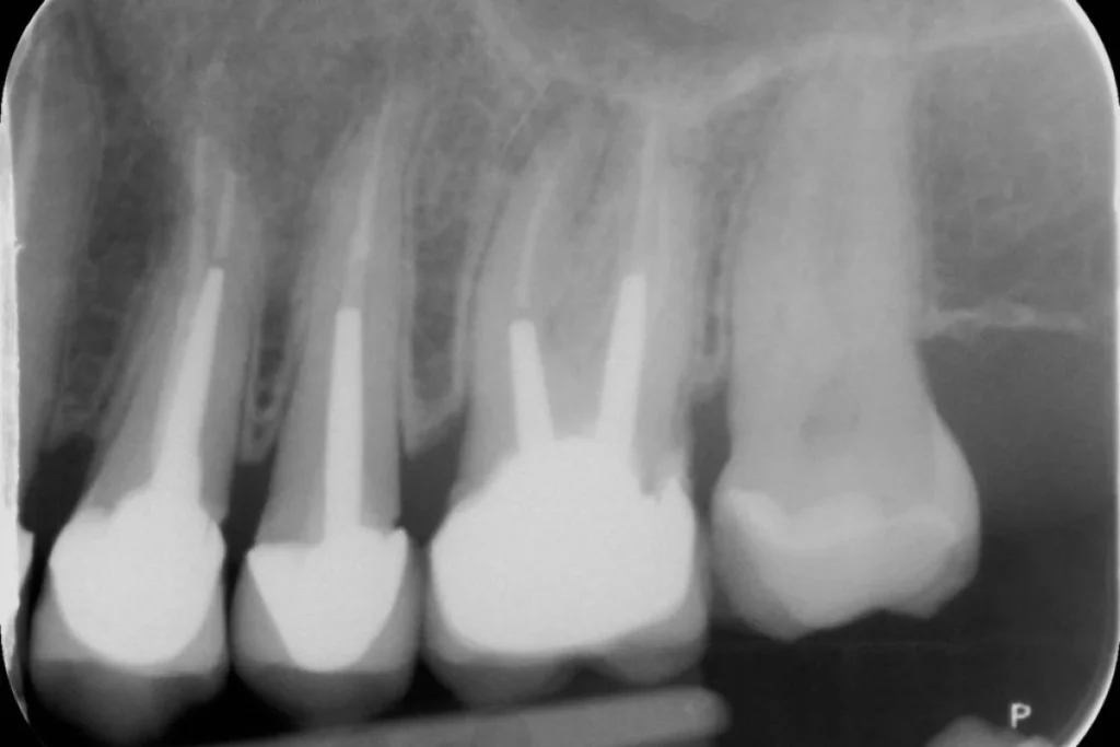 implants dentaires paris Implants dentaires | Dentiste à Paris 17 Dr Youri Emsallem Implants dentaires Paris 17