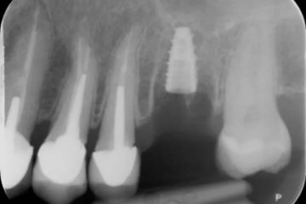 implants dentaires paris Implants dentaires | Dentiste à Paris 17 Dr Youri Emsallem Implants dentaires Paris 17
