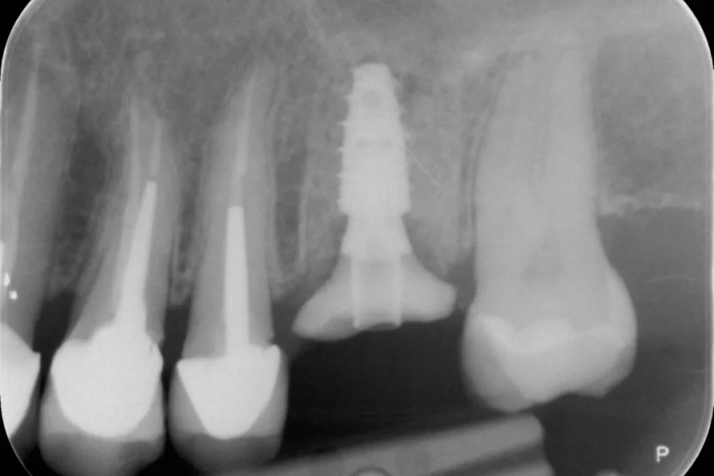 implants dentaires paris Implants dentaires | Dentiste à Paris 17 Dr Youri Emsallem Implants dentaires Paris 17