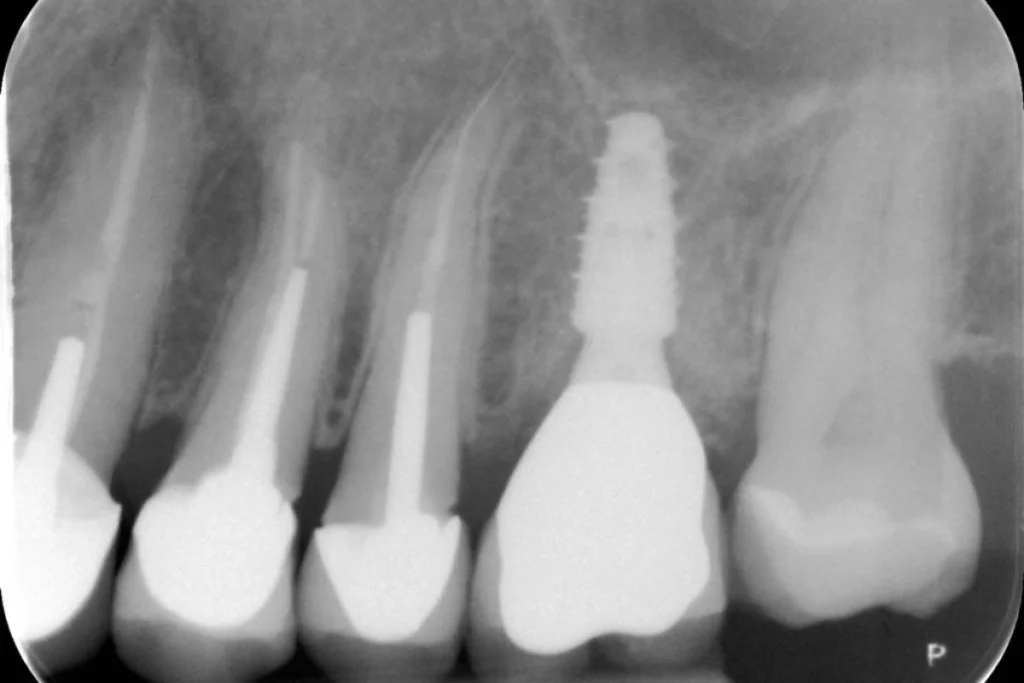 implants dentaires paris Implants dentaires | Dentiste à Paris 17 Dr Youri Emsallem Implants dentaires Paris 17