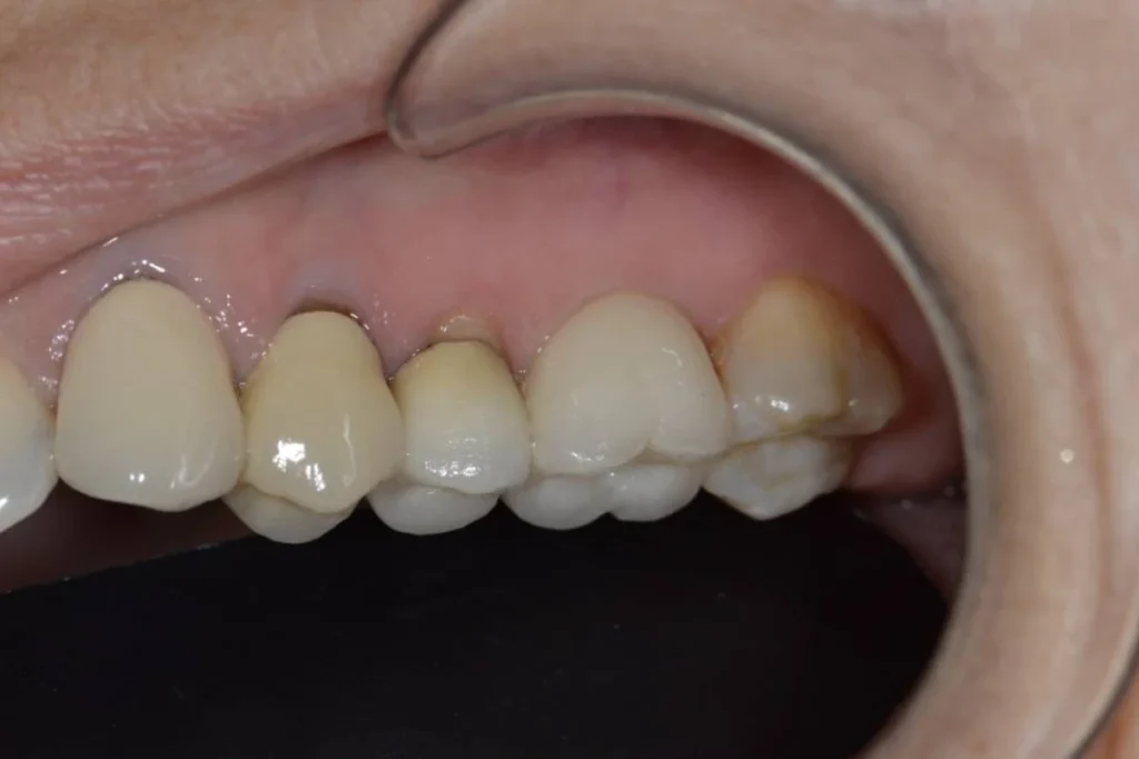 implants dentaires paris Implants dentaires | Dentiste à Paris 17 Dr Youri Emsallem Implants dentaires Paris 17