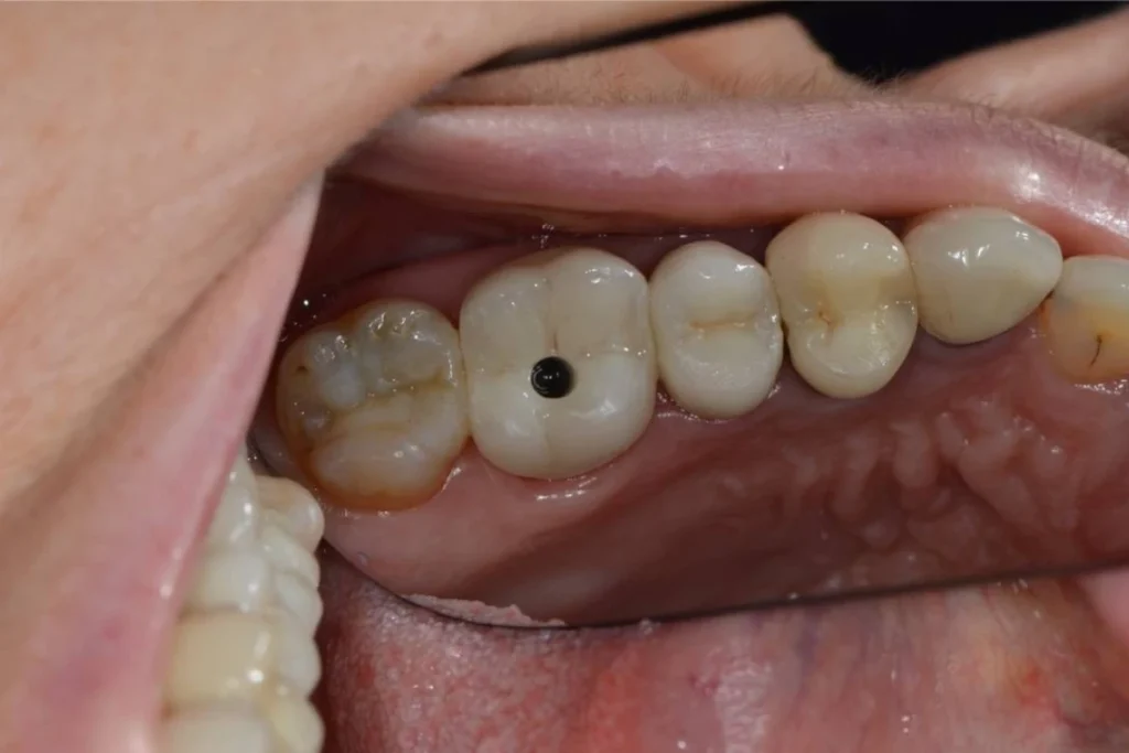 implants dentaires paris Implants dentaires | Dentiste à Paris 17 Dr Youri Emsallem Implants dentaires Paris 17