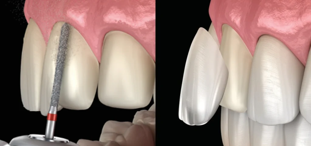 Dentisterie esthétique à Paris 17 | Dr Youri Emsallem Dentisterie esthétique