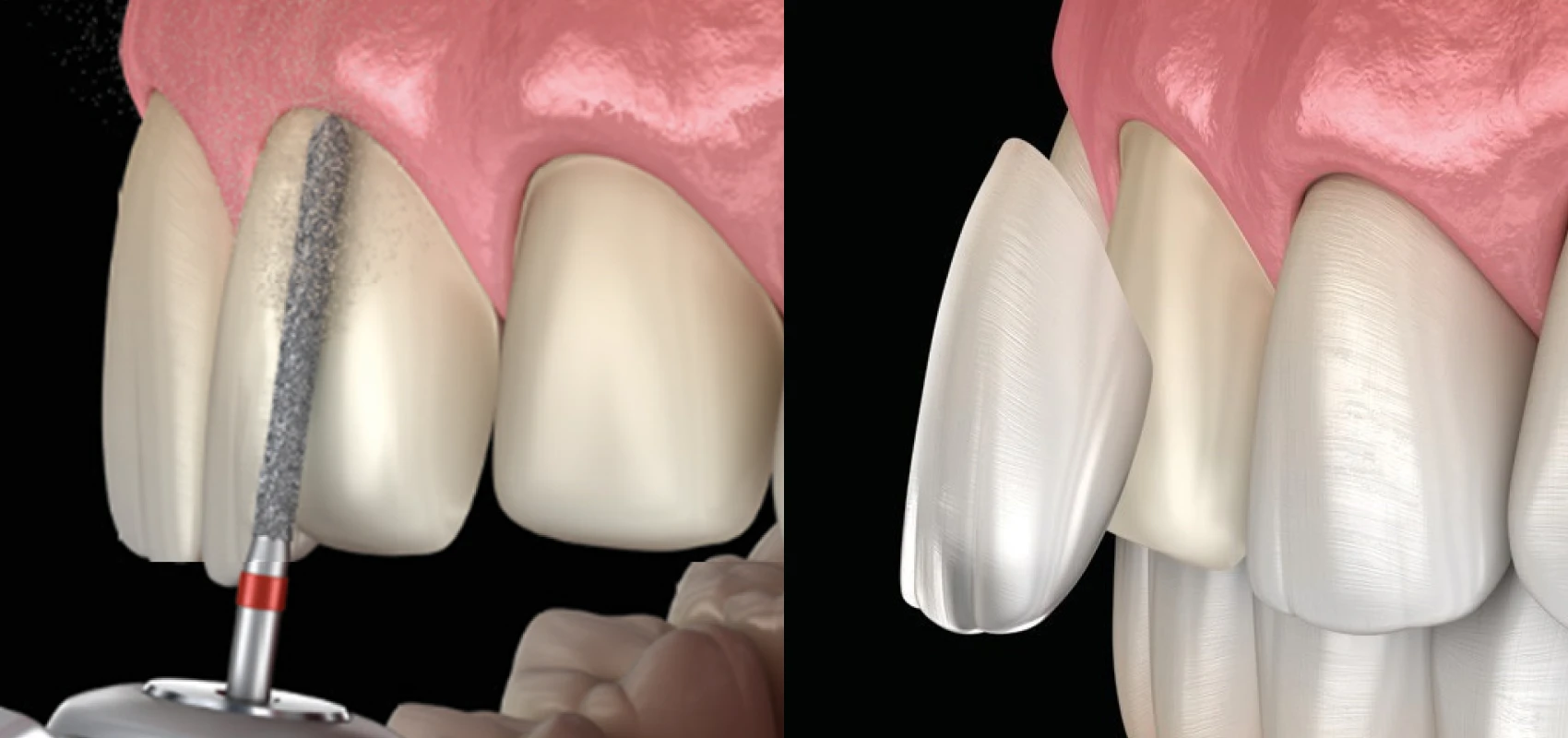 Dentisterie esthétique à Paris 17 | Dr Youri Emsallem Dentisterie esthétique