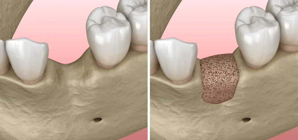 greffes osseuses dentiste paris Greffe osseuse dentaire Paris 17 - Youri Emsallem Greffe osseuse Paris 17