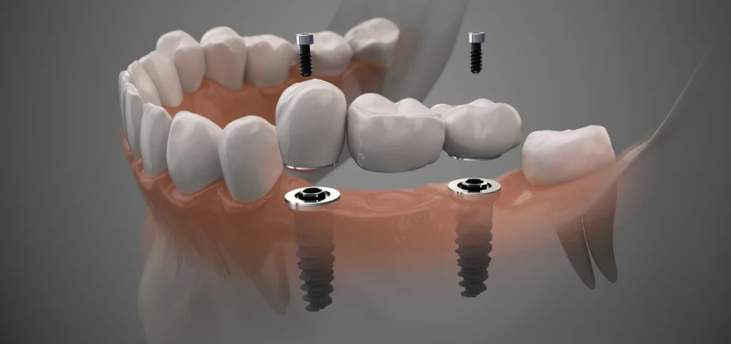 Bridge ou implant dentaire? | Dr Youri Emsallem | Dentiste Paris 17 Bridge implant dentaire paris