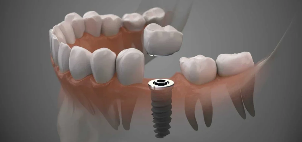 Bridge ou implant dentaire? | Dr Youri Emsallem | Dentiste Paris 17 Bridge implant dentaire paris