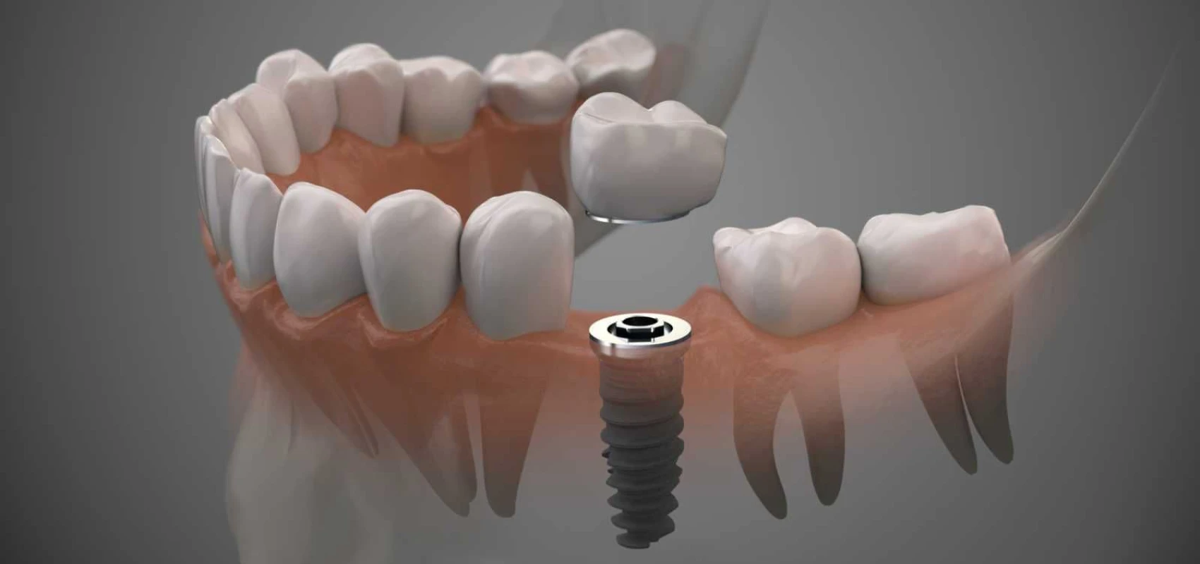 Bridge ou implant dentaire? | Dr Youri Emsallem | Dentiste Paris 17 Bridge implant dentaire paris