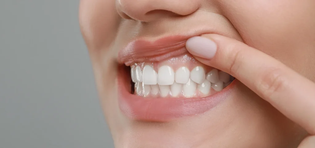 soins gencives dentiste paris Soin de gencives | Greffe de gencive | Dentiste Paris 17 Soin de gencives Paris
