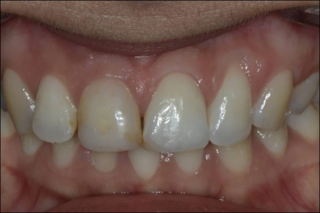blanchiment orthodontie couronne Dentisterie esthétique à Paris 17 | Dr Youri Emsallem Dentisterie esthétique