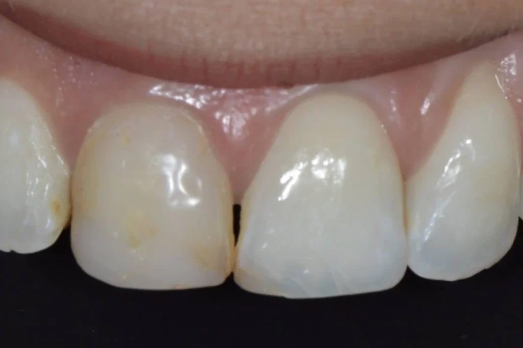 blanchiment orthodontie couronne Dentisterie esthétique à Paris 17 | Dr Youri Emsallem Dentisterie esthétique