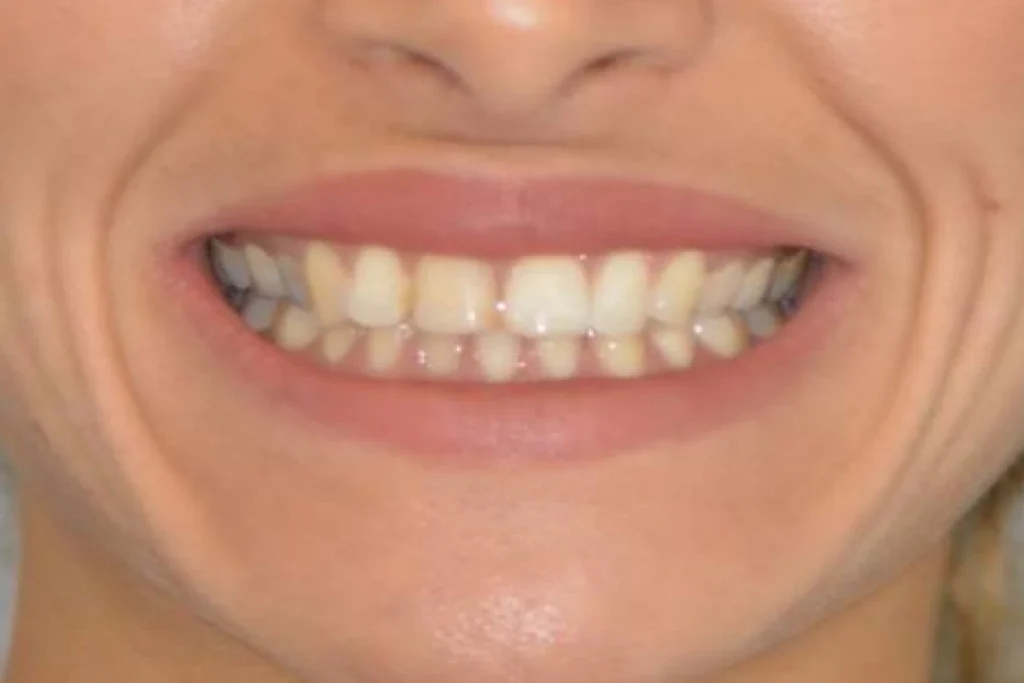 blanchiment orthodontie couronne Dentisterie esthétique à Paris 17 | Dr Youri Emsallem Dentisterie esthétique