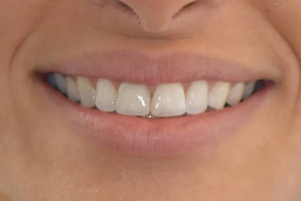 blanchiment orthodontie couronne Dentisterie esthétique à Paris 17 | Dr Youri Emsallem Dentisterie esthétique