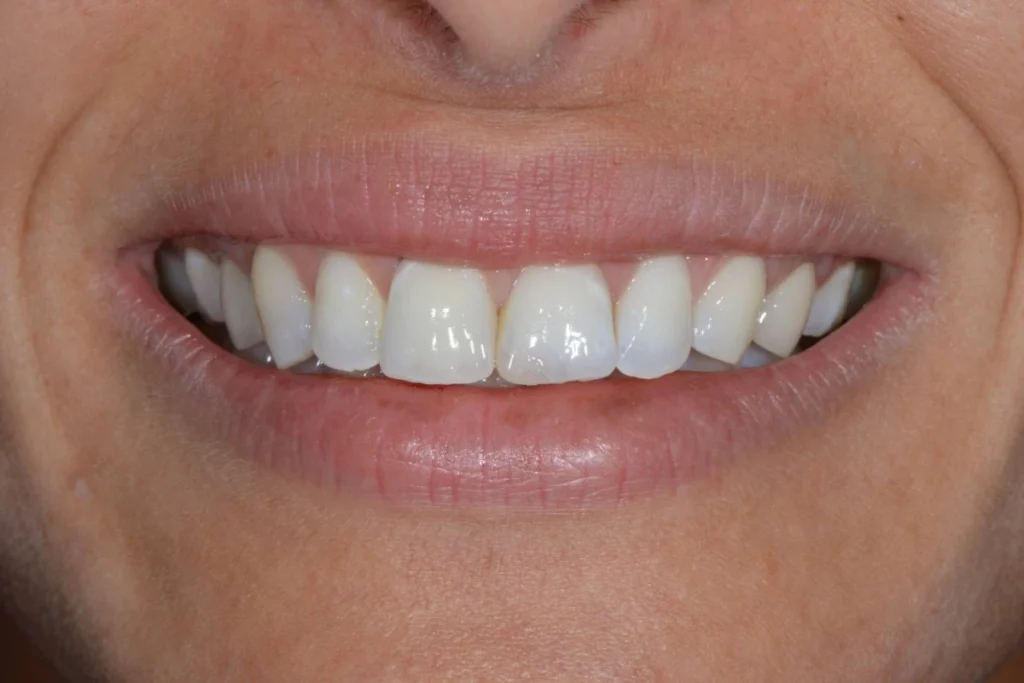 blanchiment orthodontie couronne Dentisterie esthétique à Paris 17 | Dr Youri Emsallem Dentisterie esthétique