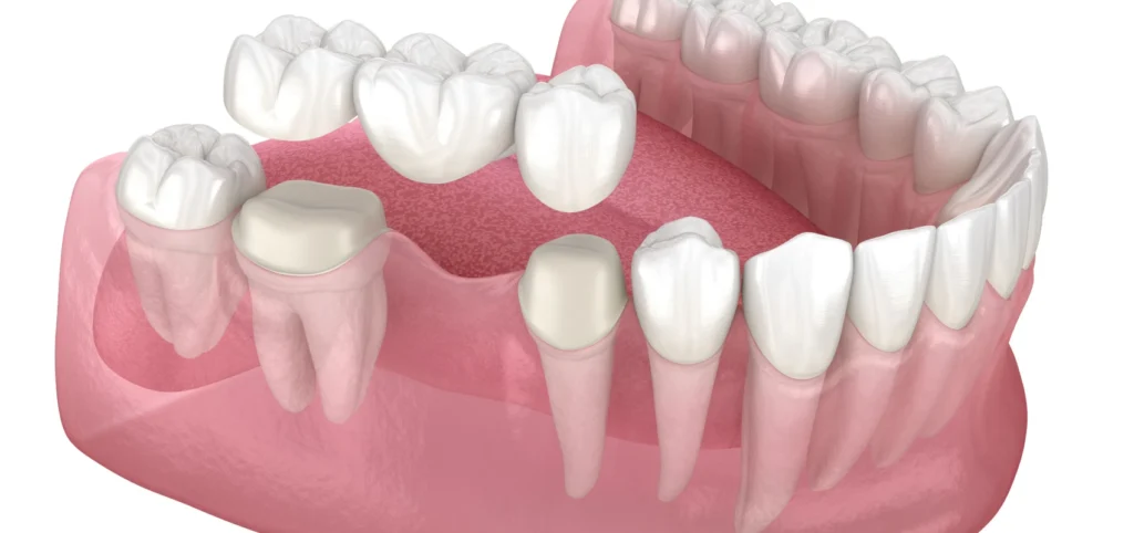 Bridge dentaire | Dr Youri Emsallem | Dentiste Paris 17 Bridge pour remplacer une dent paris