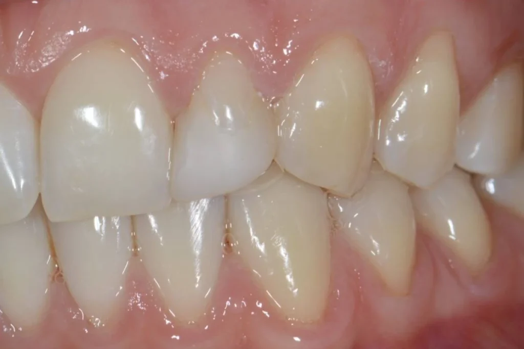 couronne dentaire paris Dentisterie esthétique à Paris 17 | Dr Youri Emsallem Dentisterie esthétique