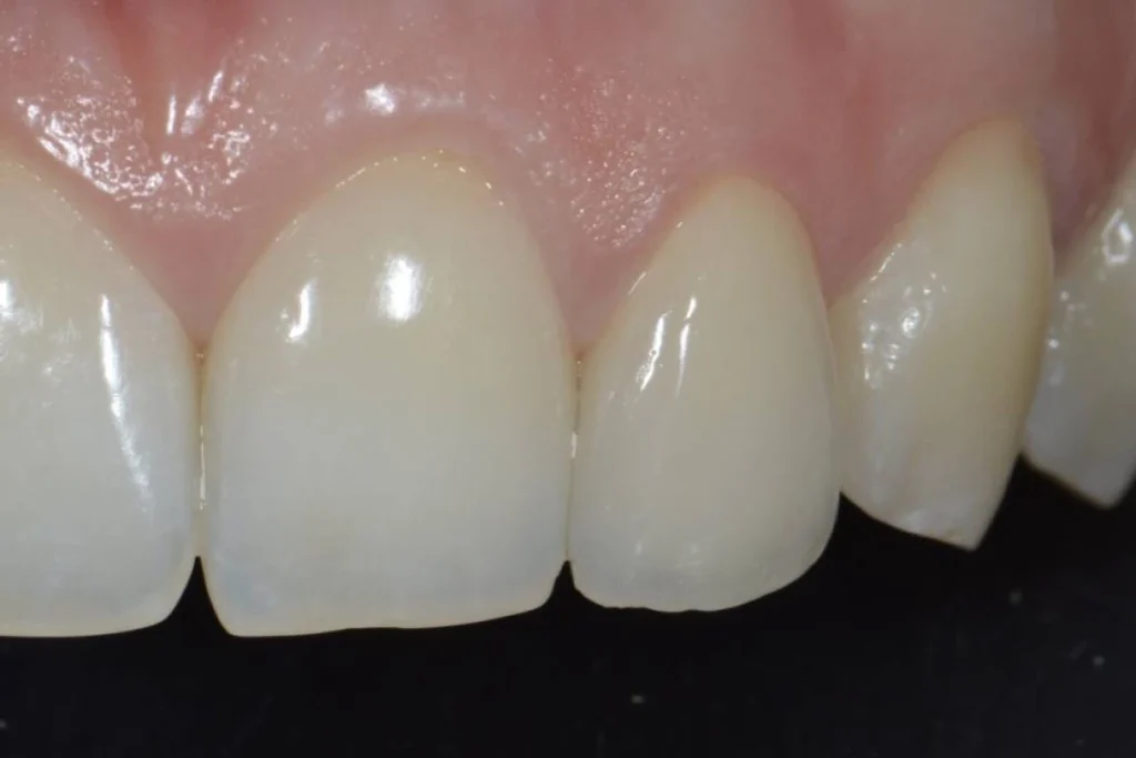 couronne dentaire paris Dentisterie esthétique à Paris 17 | Dr Youri Emsallem Dentisterie esthétique