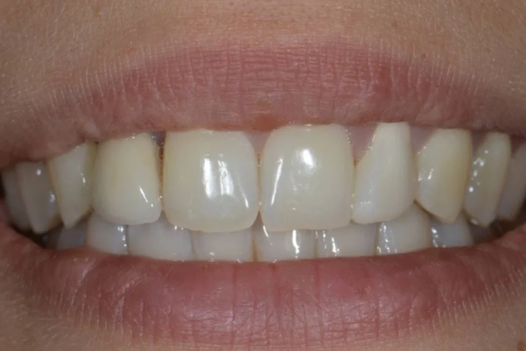 couronne dentaire paris Dentisterie esthétique à Paris 17 | Dr Youri Emsallem Dentisterie esthétique