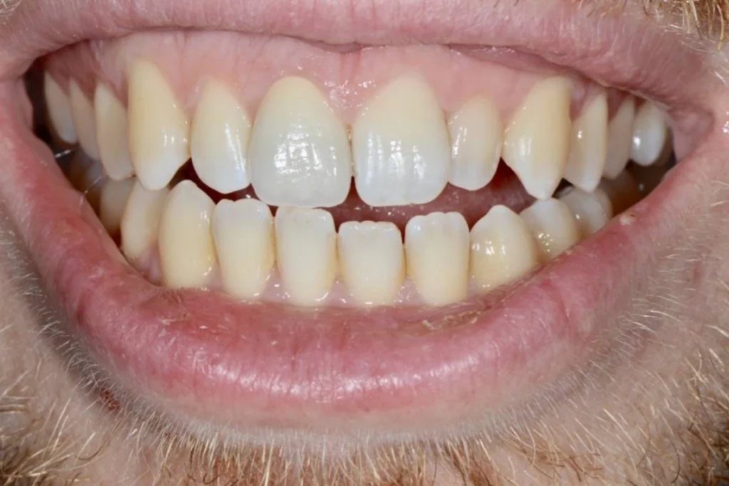 couronne dentaire paris Dentisterie esthétique à Paris 17 | Dr Youri Emsallem Dentisterie esthétique