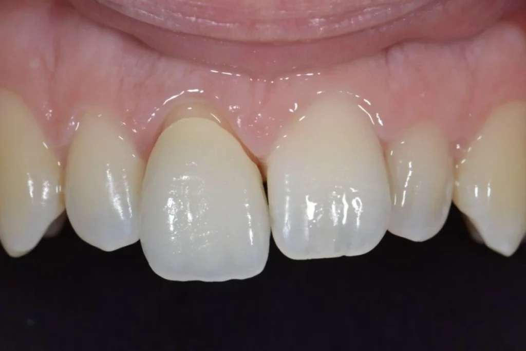 couronne dentaire paris Dentisterie esthétique à Paris 17 | Dr Youri Emsallem Dentisterie esthétique