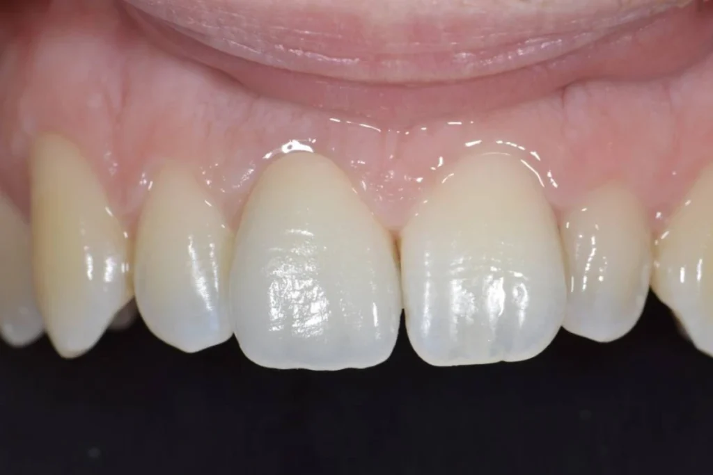 couronne dentaire paris Dentisterie esthétique à Paris 17 | Dr Youri Emsallem Dentisterie esthétique