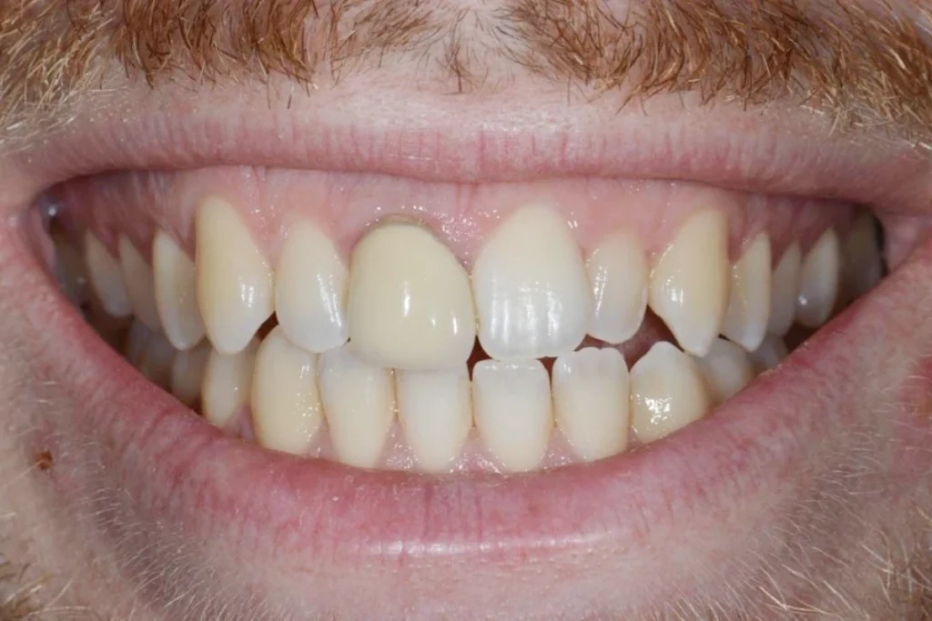 couronne dentaire paris Dentisterie esthétique à Paris 17 | Dr Youri Emsallem Dentisterie esthétique