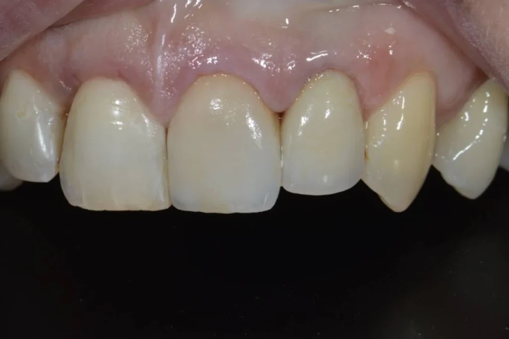 couronne facette dentaire Dentisterie esthétique à Paris 17 | Dr Youri Emsallem Dentisterie esthétique