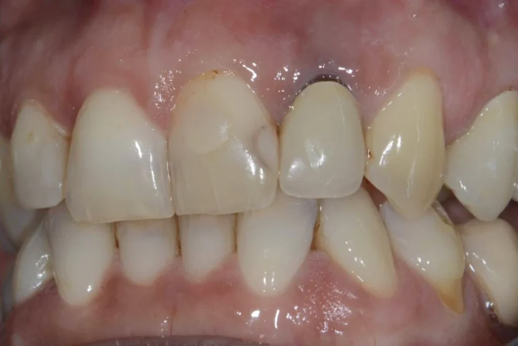 couronne facette dentaire Dentisterie esthétique à Paris 17 | Dr Youri Emsallem Dentisterie esthétique