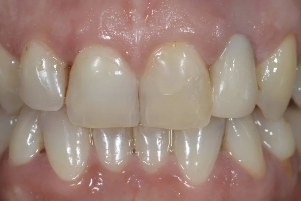couronne facette dentaire Dentisterie esthétique à Paris 17 | Dr Youri Emsallem Dentisterie esthétique