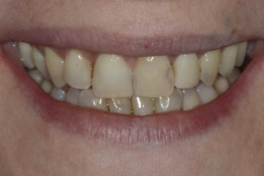 couronne facette dentaire Dentisterie esthétique à Paris 17 | Dr Youri Emsallem Dentisterie esthétique