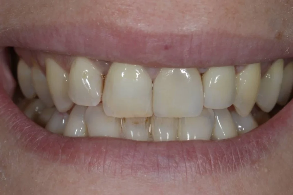 couronne facette dentaire Dentisterie esthétique à Paris 17 | Dr Youri Emsallem Dentisterie esthétique