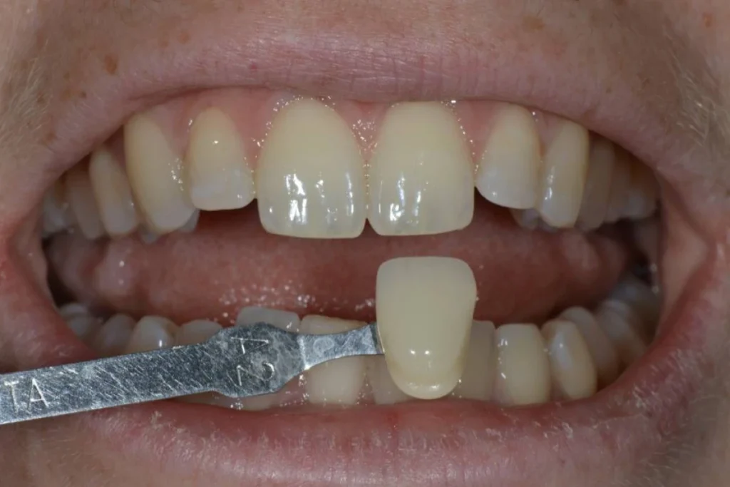 eclaircissement blanchiment dentaire paris Dentisterie esthétique à Paris 17 | Dr Youri Emsallem Dentisterie esthétique
