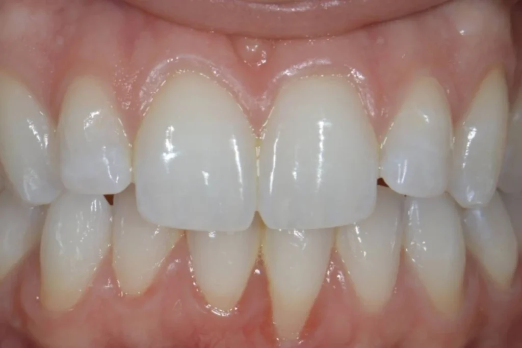 eclaircissement blanchiment dentaire paris Dentisterie esthétique à Paris 17 | Dr Youri Emsallem Dentisterie esthétique