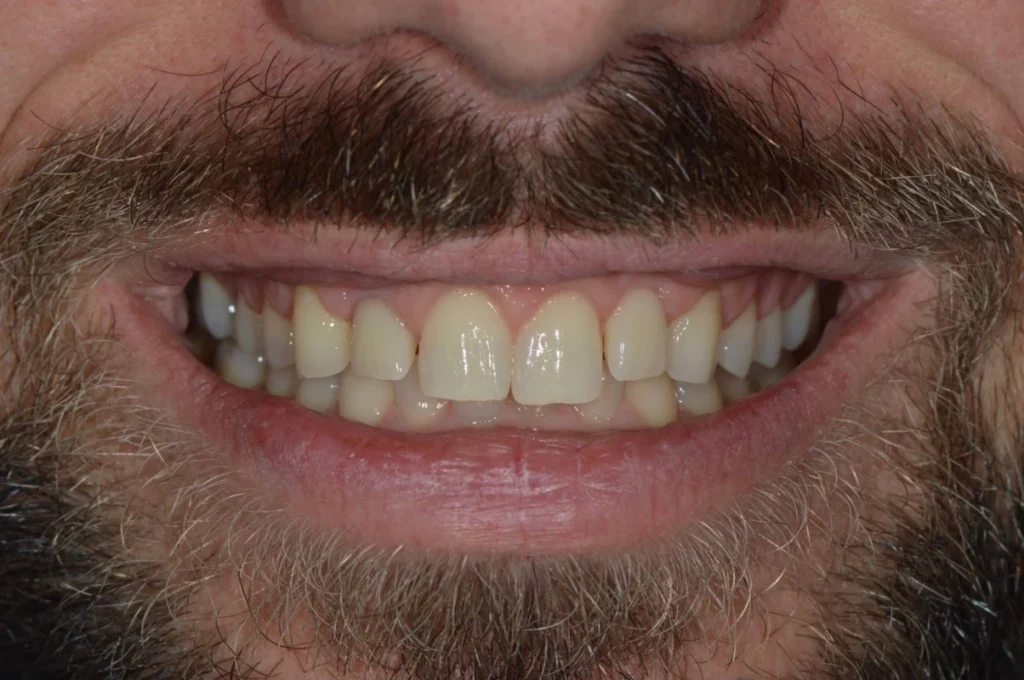 elongation coronaire paris Soin de gencives | Greffe de gencive | Dentiste Paris 17 Soin de gencives Paris