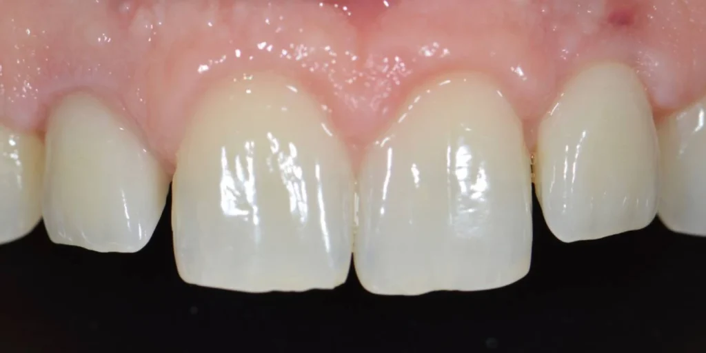elongation coronaire paris Soin de gencives | Greffe de gencive | Dentiste Paris 17 Soin de gencives Paris