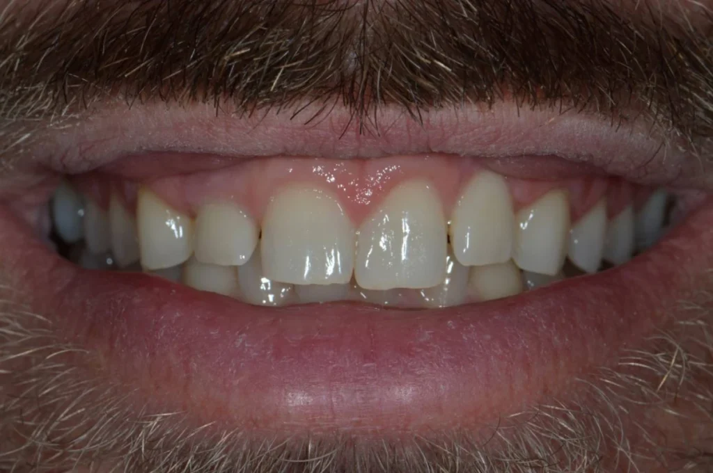 elongation coronaire paris Soin de gencives | Greffe de gencive | Dentiste Paris 17 Soin de gencives Paris