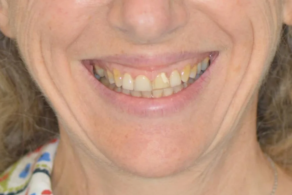facettes dentaire paris Dentisterie esthétique à Paris 17 | Dr Youri Emsallem Dentisterie esthétique