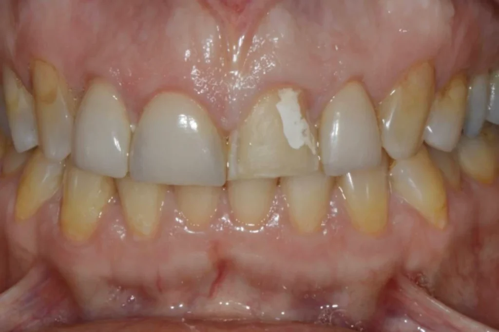 facettes dentaire paris Dentisterie esthétique à Paris 17 | Dr Youri Emsallem Dentisterie esthétique