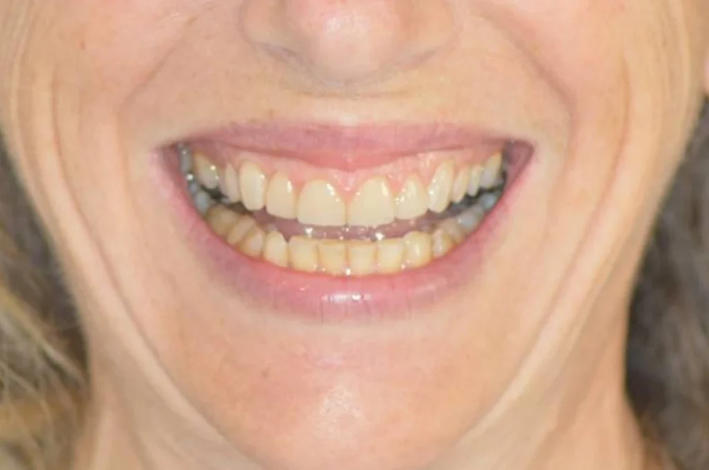 facettes dentaire paris Dentisterie esthétique à Paris 17 | Dr Youri Emsallem Dentisterie esthétique
