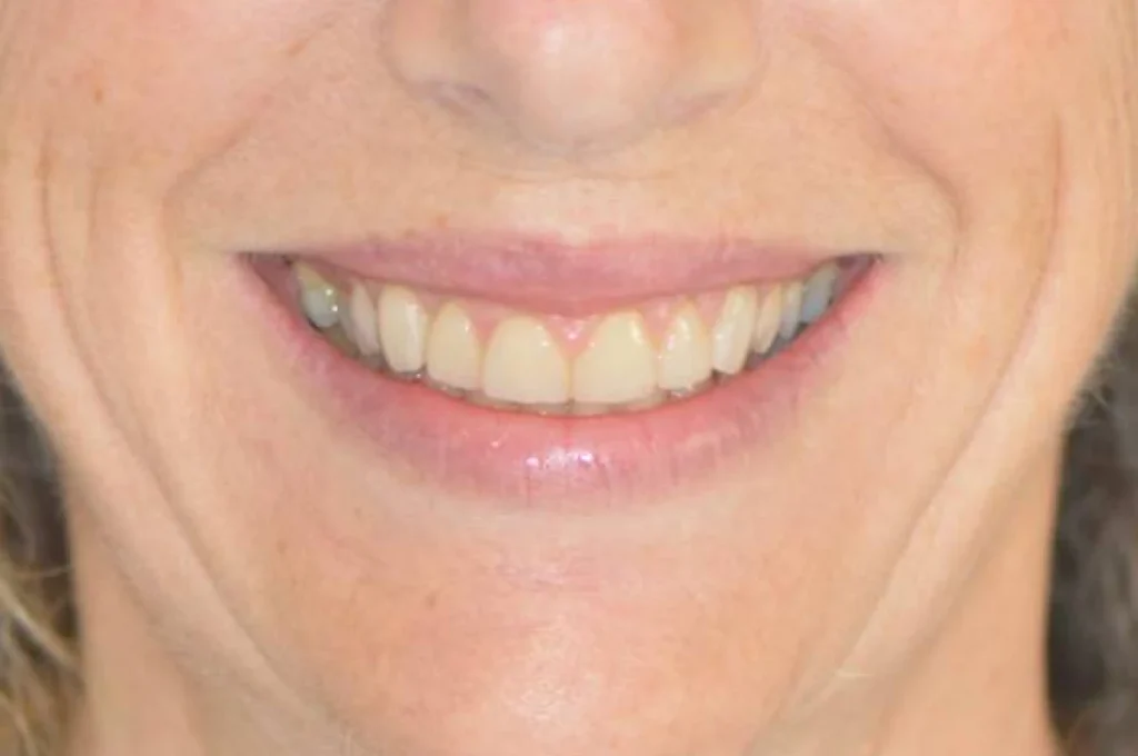 facettes dentaire paris Dentisterie esthétique à Paris 17 | Dr Youri Emsallem Dentisterie esthétique