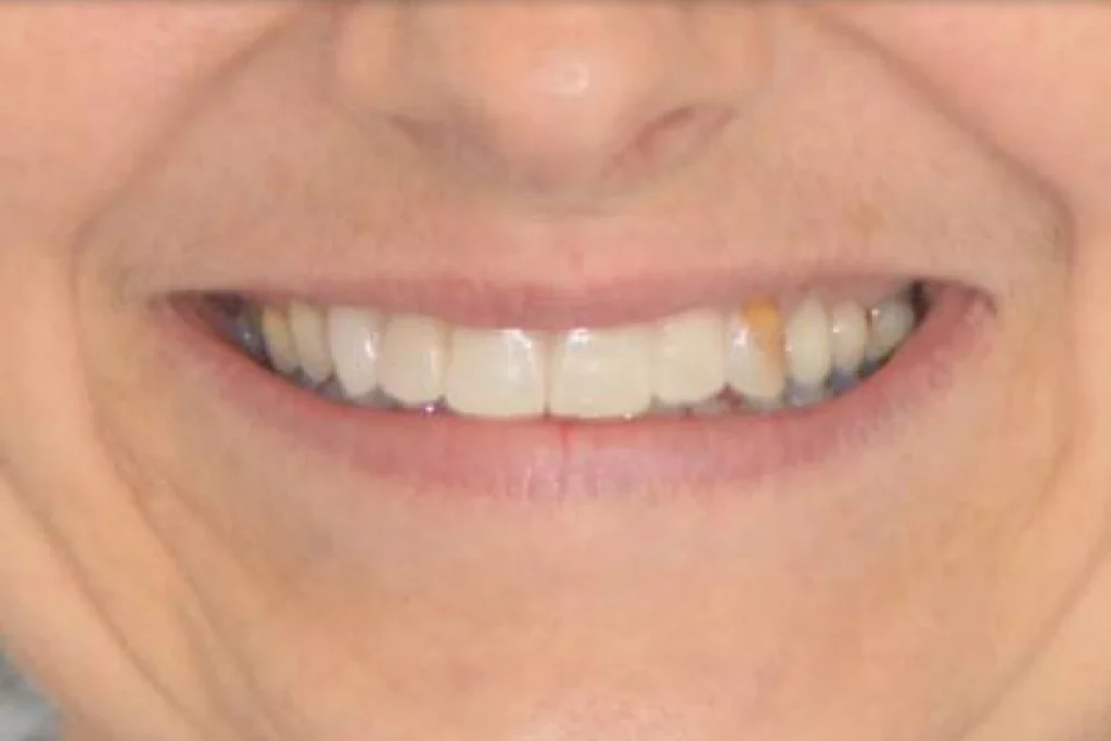 facettes dentaires paris Dentisterie esthétique à Paris 17 | Dr Youri Emsallem Dentisterie esthétique