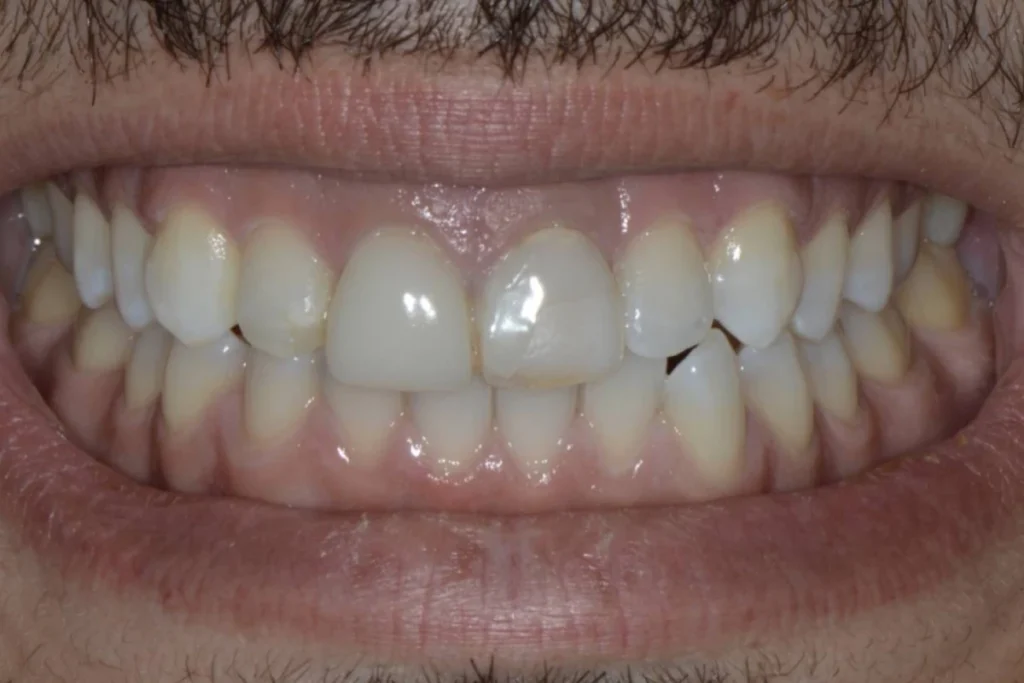 facettes dentaires paris Dentisterie esthétique à Paris 17 | Dr Youri Emsallem Dentisterie esthétique